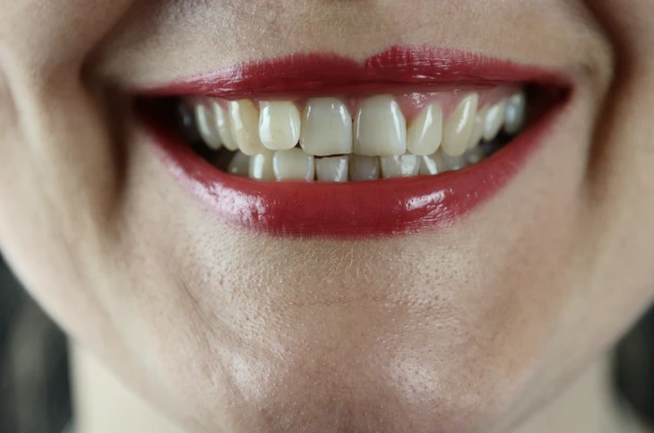 Invisalign Before and After