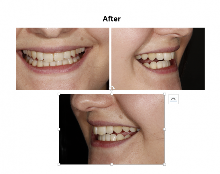 Invisalign after