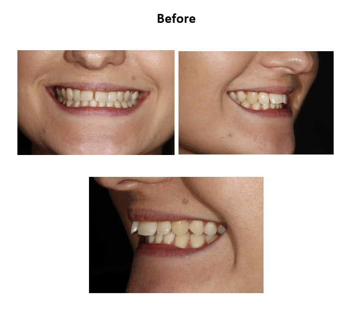 Invisalign before