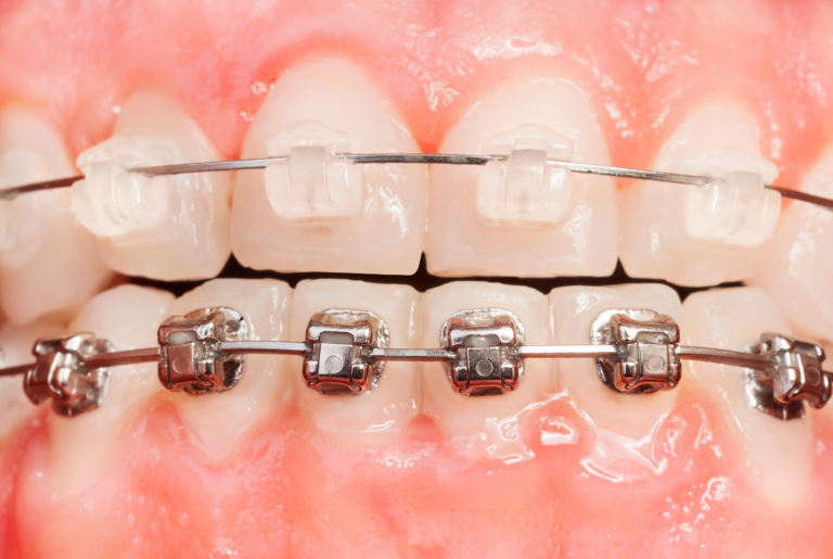 Metal Braces
