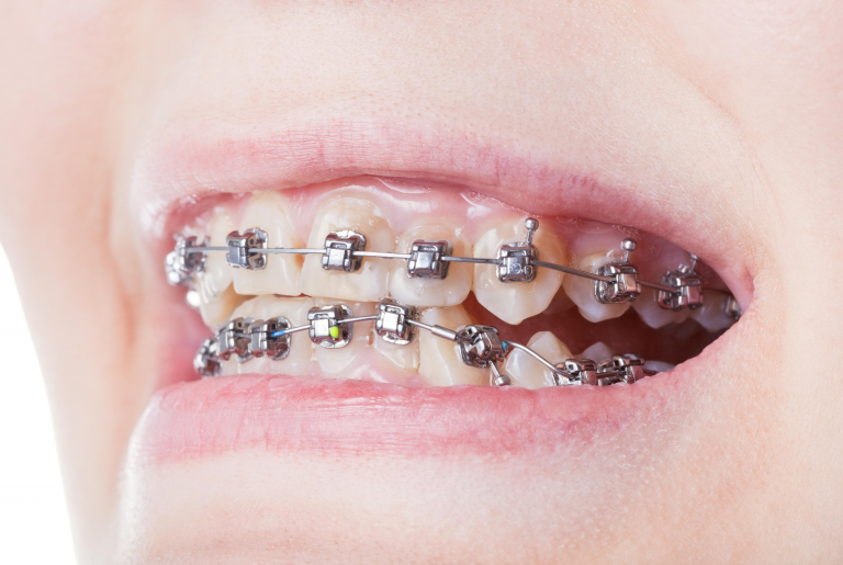 Self-ligating braces