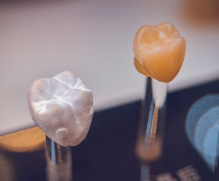 Types of Dental crowns