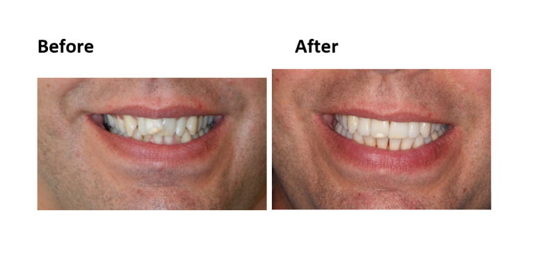 Invisalign Before and After