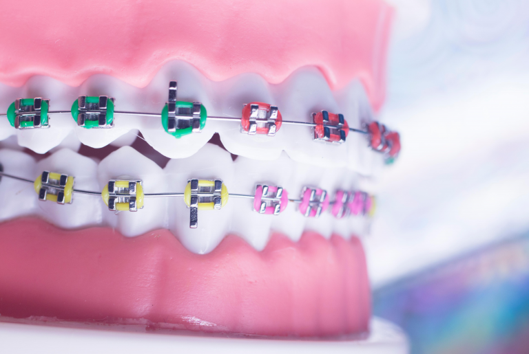 cost of Clear Aligners