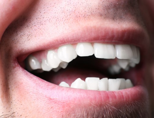 crowded teeth- six month smile