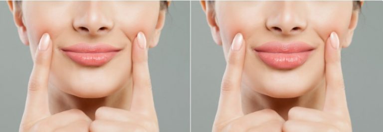 derma fillers before after