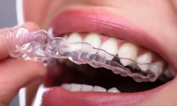 How do Inman Aligners Work