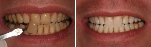 Tooth whitening before and after