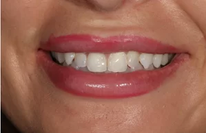 composite bonding after image