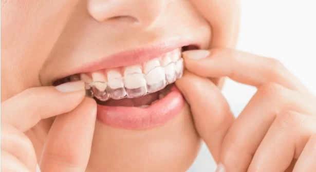 Invisalign cost in the UK