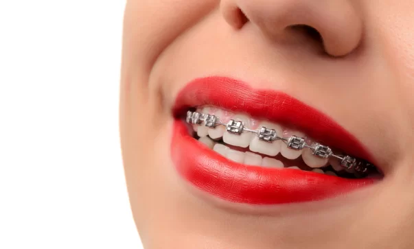 Six month Smiles Vs Metal Braces