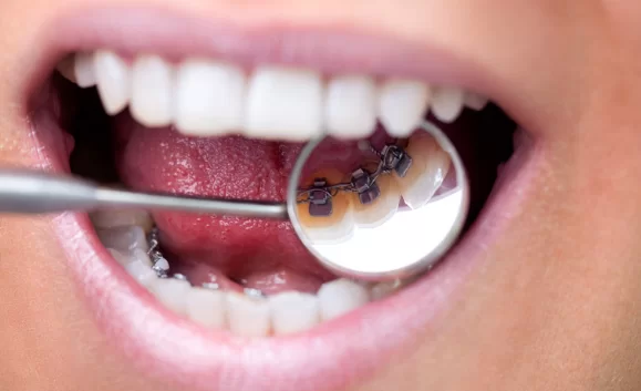 Six Month Smiles Vs Lingual Braces