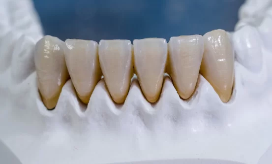 Are Zirconia Veneers Good