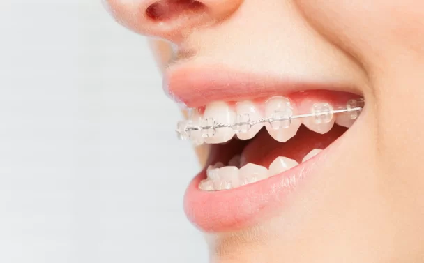 How do Clear Braces Work