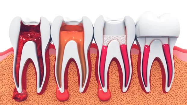 Root Canal