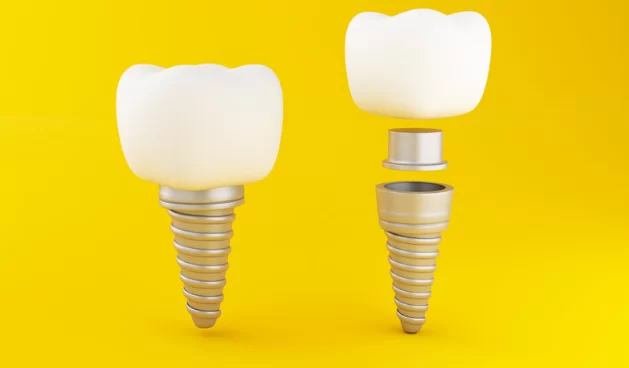 Dental Implants FAQ