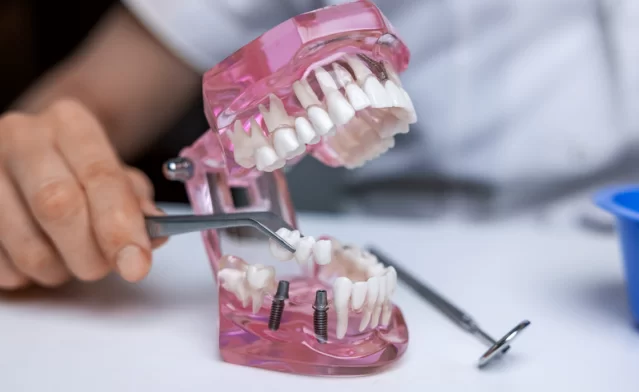 Dental Bridge