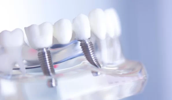 Implant Supported Dentures