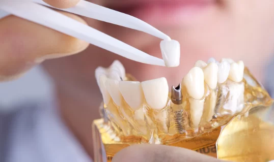 What are Dental Implants