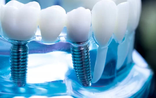 Who should opt for Full Arch Dental Implant