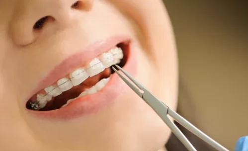 Who should get a Ceramic Filling