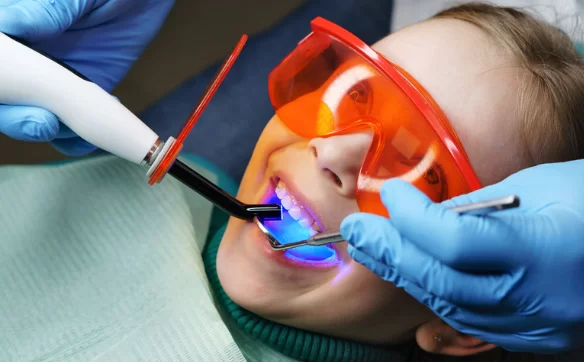 How does Ceramic Filling Fitted