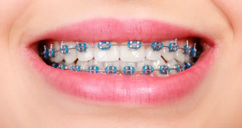 Advantages of Regular Braces