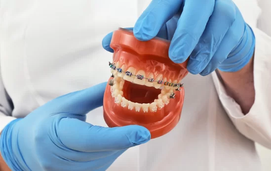 Disadvantages of Six Month Braces