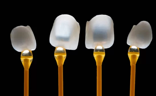 Pros and Cons of Veneers