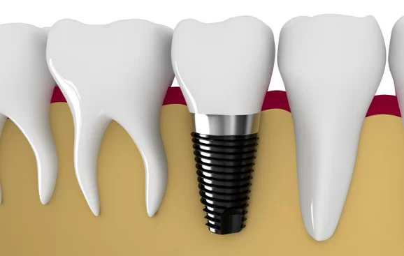 What are Dental Implants