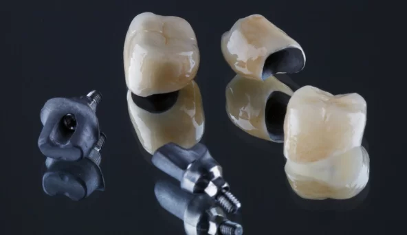 Benefits of CEREC for front teeth