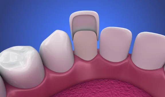 What Are Porcelain Veneers
