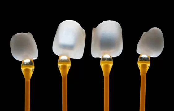 What Makes Veneers Last Long.