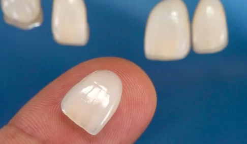 Minimum age to get veneers