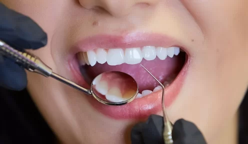 Process of getting veneers