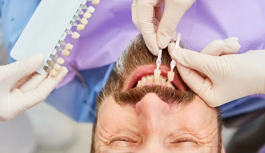 How often do composite veneers need to be replaced