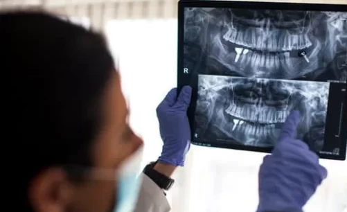 Before Dental Implants