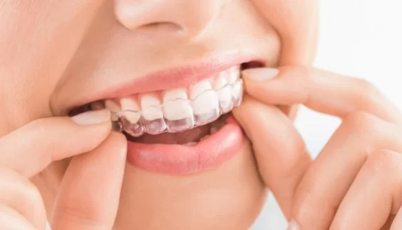 Benefits of Invisalign i7