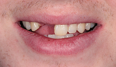 Before - Natural Smiles Implant & Cosmetic Dentistry
