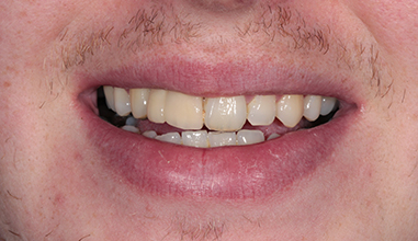 Before - Natural Smiles Implant & Cosmetic Dentistry