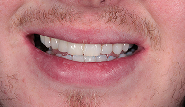 After - Natural Smiles Implant & Cosmetic Dentistry