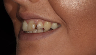 Before - Natural Smiles Implant & Cosmetic Dentistry