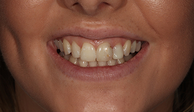 Before - Natural Smiles Implant & Cosmetic Dentistry