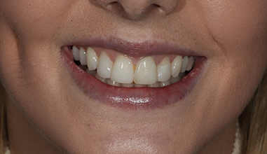 After - Natural Smiles Implant & Cosmetic Dentistry