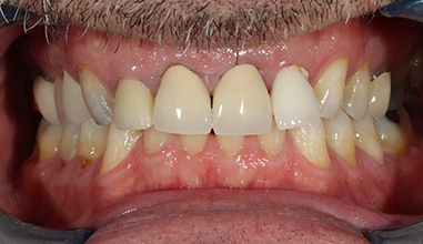 Before - Natural Smiles Implant & Cosmetic Dentistry