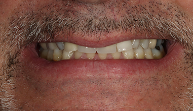 Before - Natural Smiles Implant & Cosmetic Dentistry