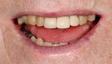 After - Natural Smiles Implant & Cosmetic Dentistry