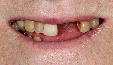 Before - Natural Smiles Implant & Cosmetic Dentistry