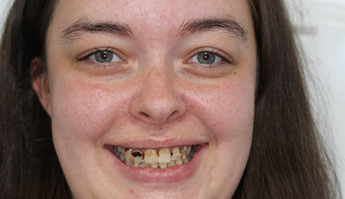 Before - Natural Smiles Implant & Cosmetic Dentistry