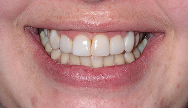After - Natural Smiles Implant & Cosmetic Dentistry